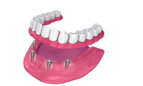 Dental Implants