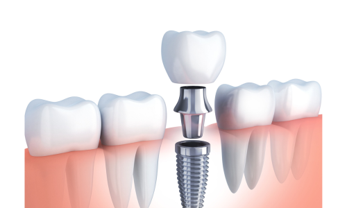 Dental Implants