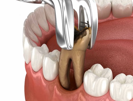 Removal of damaged teeth
